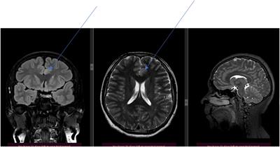 Case report: First experience with stimulating anterior thalamic nuclei in pharmacoresistant epilepsy in Kazakhstan